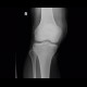 Fracture of patella: X-ray - Plain radiograph